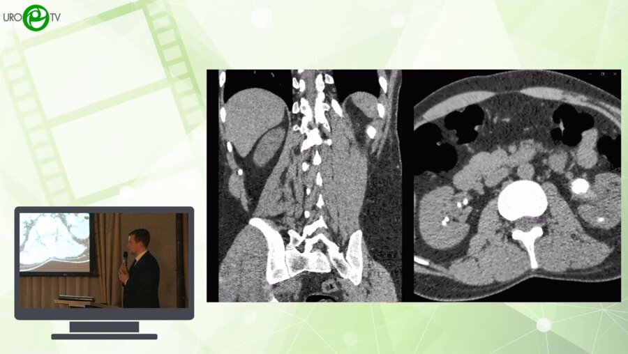Петров А.Д. - Двусторонняя одноэтапная комбинированная ПНЛ слева и гибкая УРС справа при билатеральном нефролитиазе