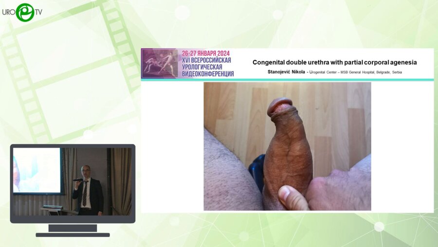 Станоевич Н. - Congenital double urethra and corporal agenesia