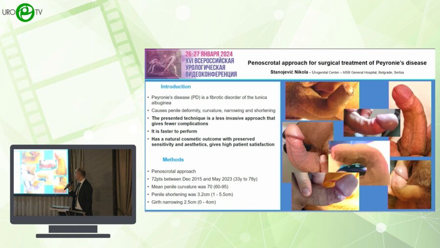 Станоевич Н. - Penoscrotal approach for surgical treatment of Peyronies disease