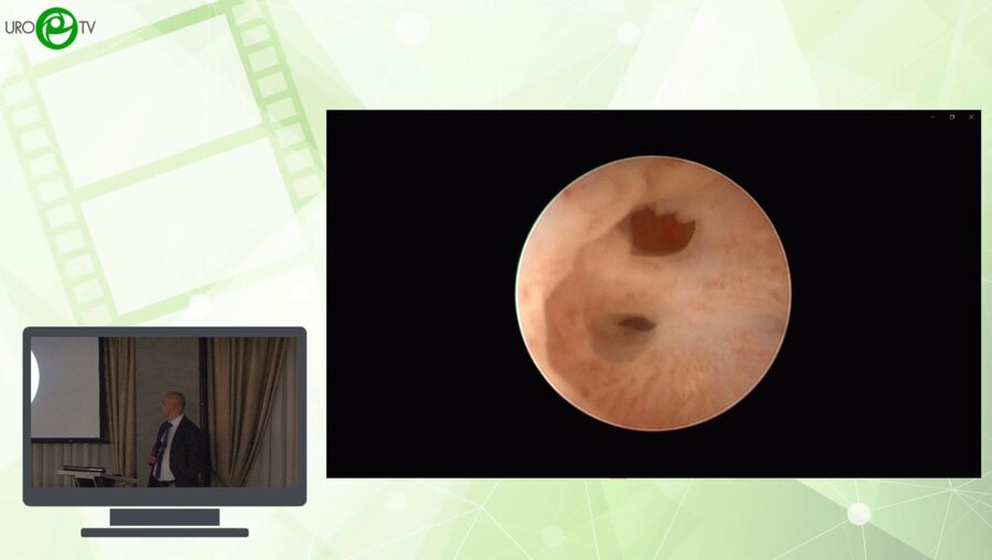 Шкодкин С.В. - Этапная пластика уретры - для кого?