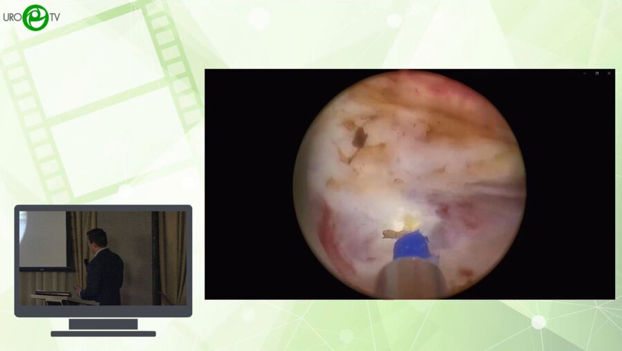 Гах Д.В. - Трансуретральная лазерная энуклеация гиперплазии предстательной железы после чреспузырной аденомжктомии и ТУР