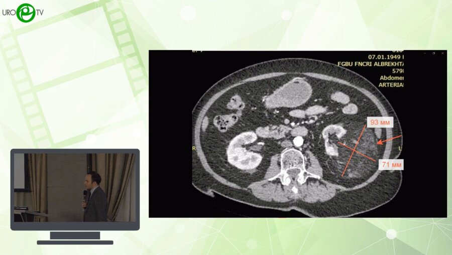 Перфильев М.А. - Эндоваскулярные подходы в лечении онкоурологических заболеваний