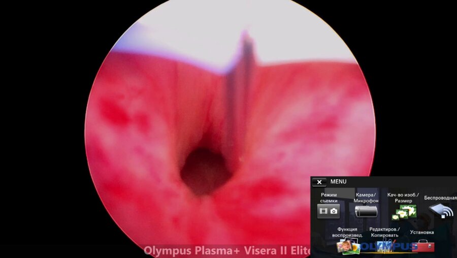 Шкодкин С.В. - Энуклеация аденомы простаты