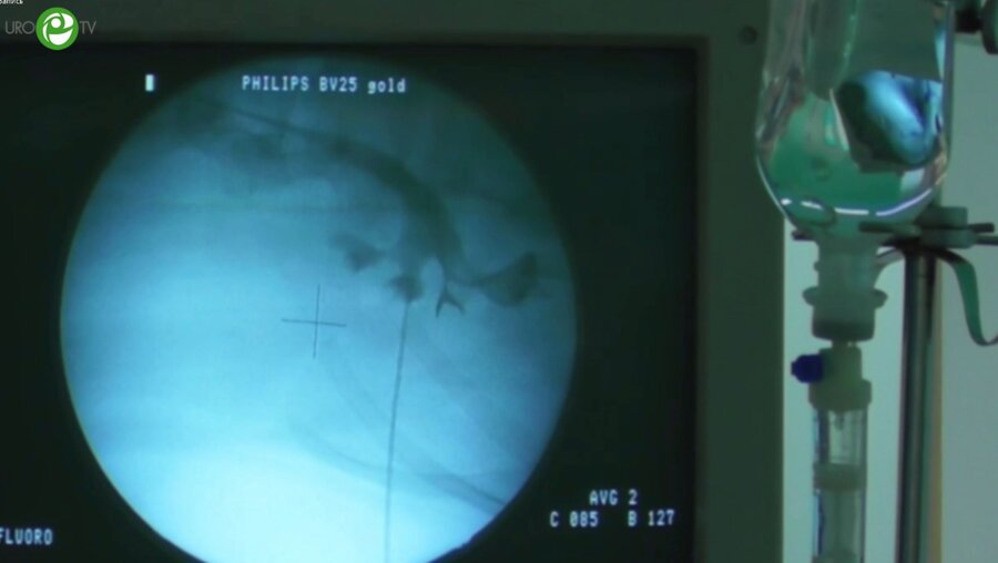 Панфёров А.С. - Миниперкутанная нефролитотрипсия