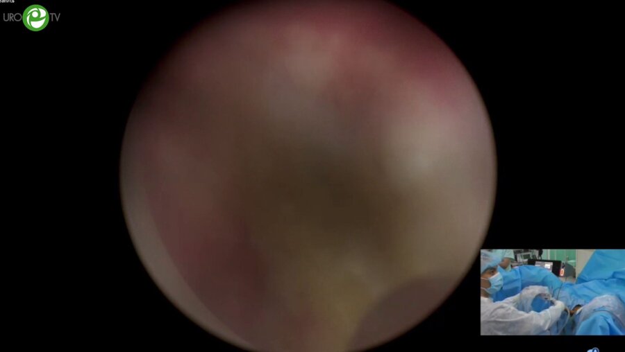 Сорокин Н.И. - Трансуретральная лазерная энуклеация