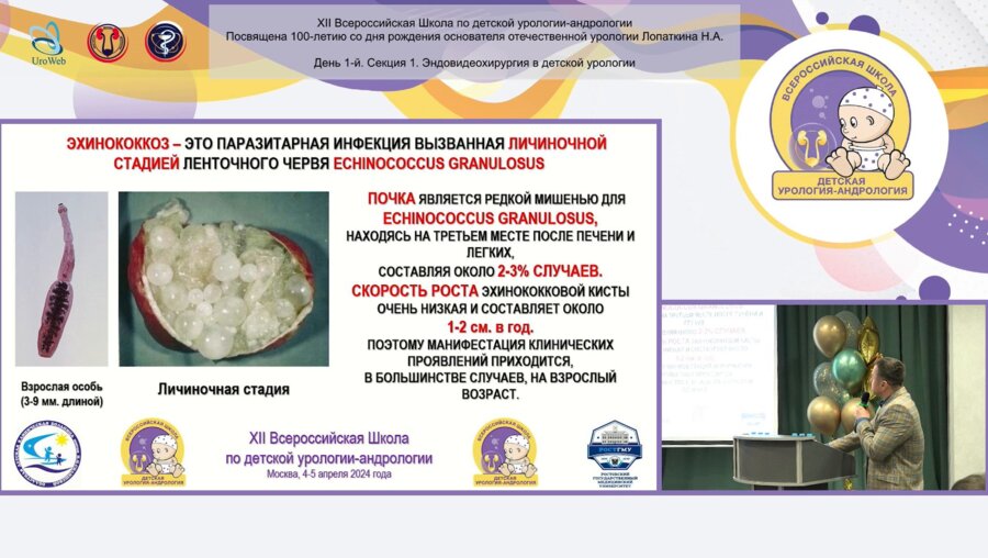 Пирогов А.В., Сизонов В.В, Коган М.И. - Ретроперитонеоскопическое удаление эхинококковой кисты левой почки у девочки 8 лет