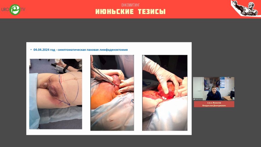 Яковлев В.Д. - Рак полового члена - когда можно сохранить анатомию и функцию?