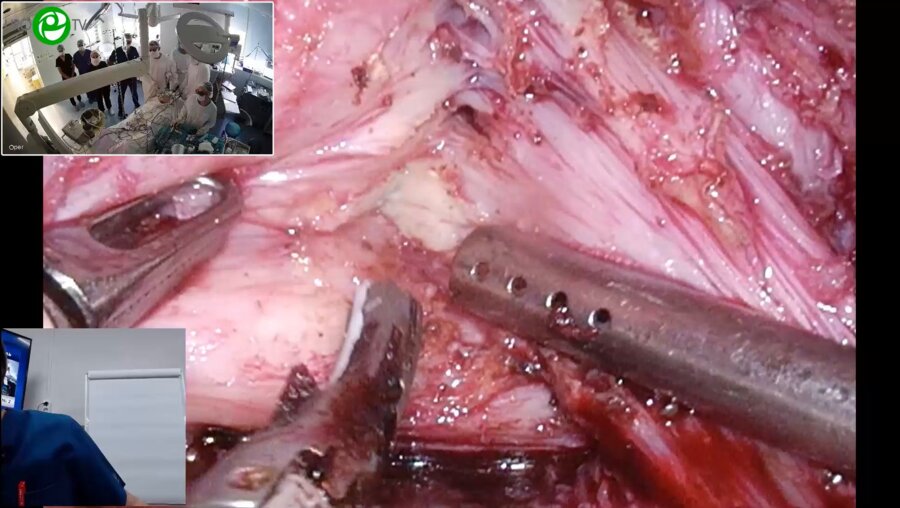 Еременко А.Н. - 3D ВЛС интерфасциальная нервосберегающая радикальная простатэктомия с реконструкцией уретры