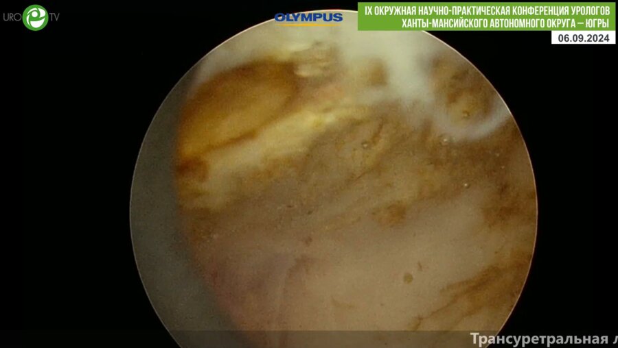 Дымов А.М. - Трансуретральная лазерная энуклеция аденомы простаты