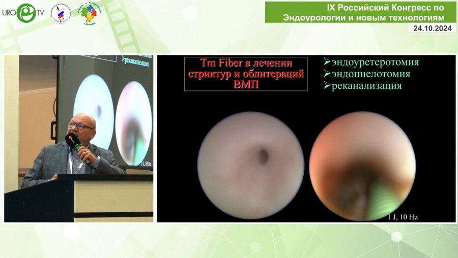 Мартов А.Г. - ТВЛ в лечении других заболеваний ВМП (папиллярный рак, стриктуры, синусные кисты и др.)