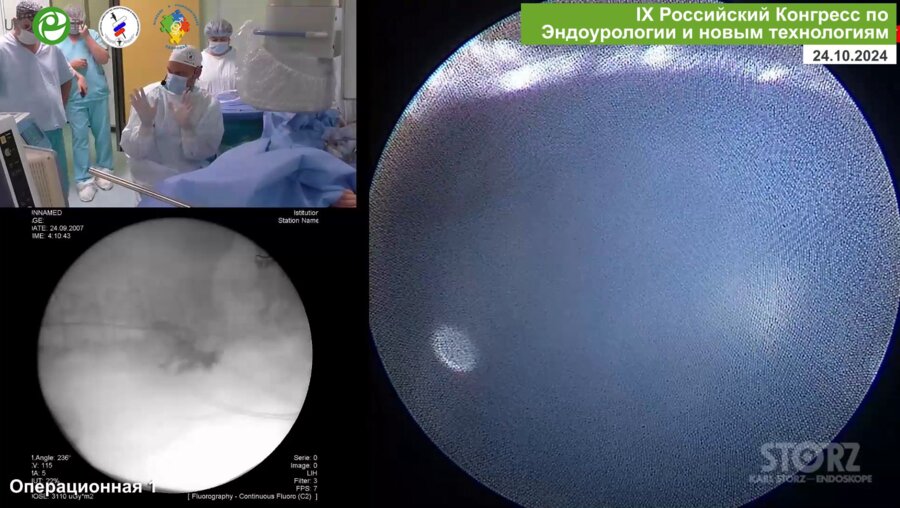 Панфёров А.С. - Лазерная Мини-ПНЛ в положении на спине
