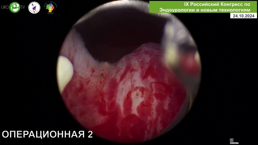 Сорокин Н.И. - Биполярная ТУР простаты