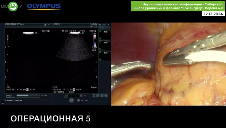 Новиков А.Б. - Лапароскопическая резекция почки