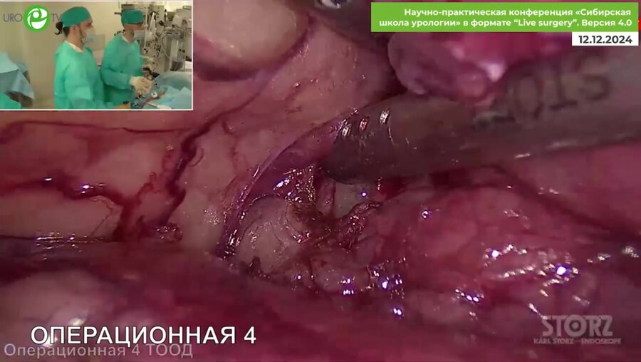 Симонов П.А. - Лапароскопическая резекция почки, нефрэктомия