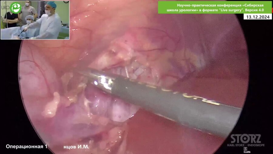 Каганцов И.М. - Лапароскопическая пластика ЛМС