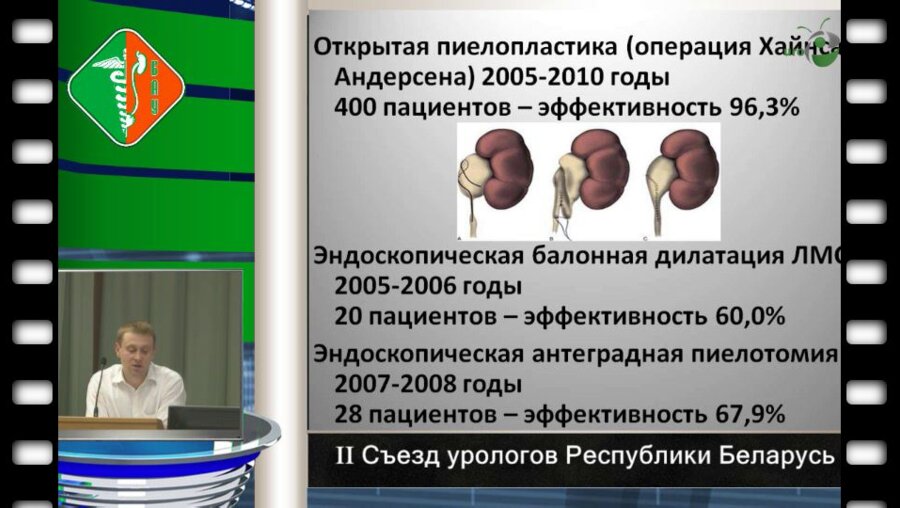 Дубров В.И. - Результаты применения лапароскопической пиелопластики при гидронефрозе у детей.  