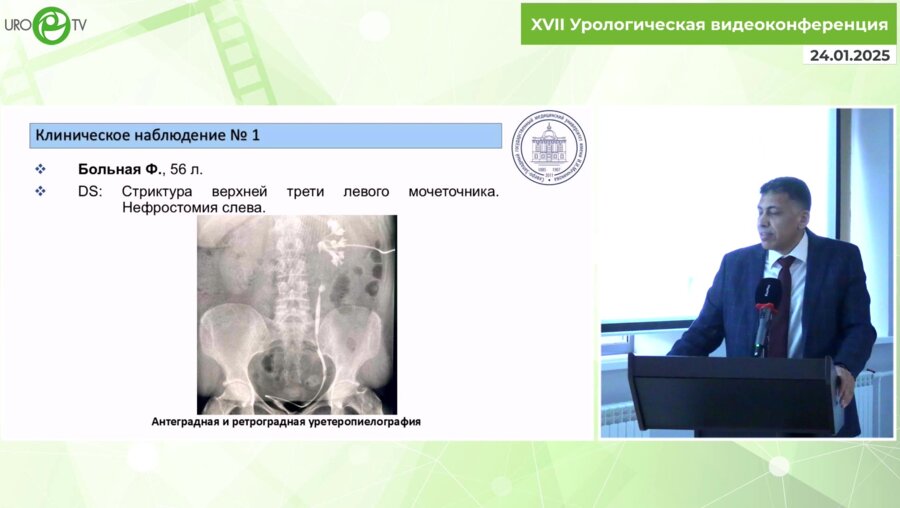 Ал-Аттар Т.Х. - Лапароскопический уретероуретероанастомоз. Возможности метода
