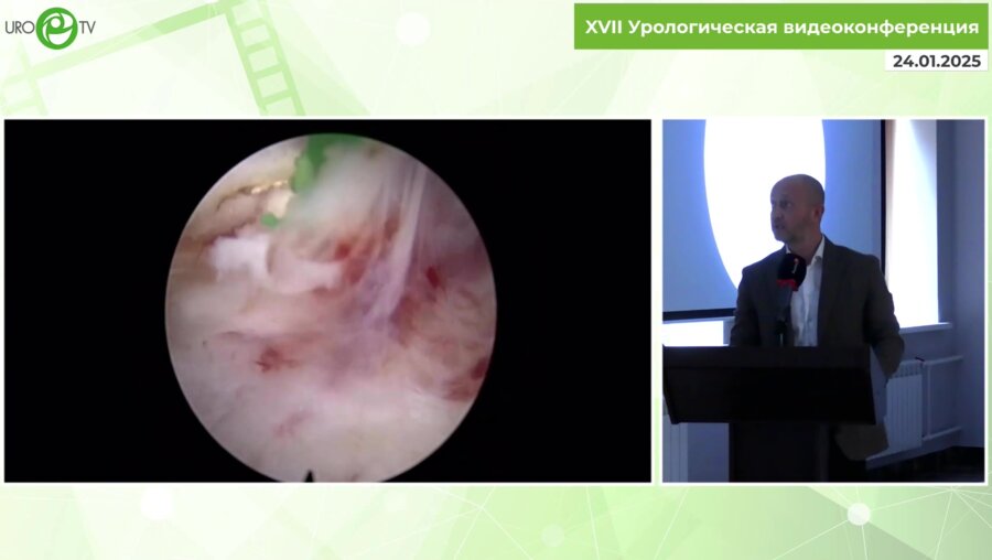 Бадьян К.И. -  Лазерная энуклеация простаты единым блоком