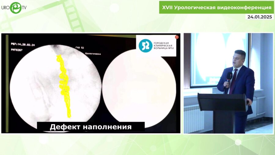 Медведев П.Е. - Лапароскопическая нефруретерэктомия при раке мочеточника с расширенной лимфаденэктомией