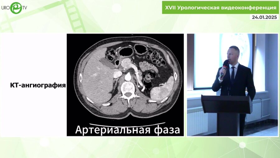 Милошевский П.В. - Лапароскопическая резекция опухоли подковообразной почки - всегда с приключениями