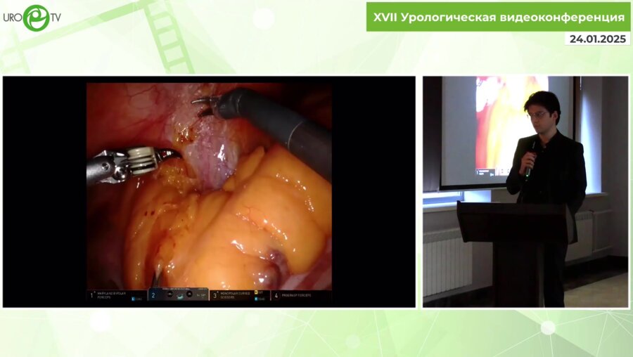 Маммаев Р.У. - Технические особенности радикальной робот-ассистированной Ретциус-сберегающей простатэктомии