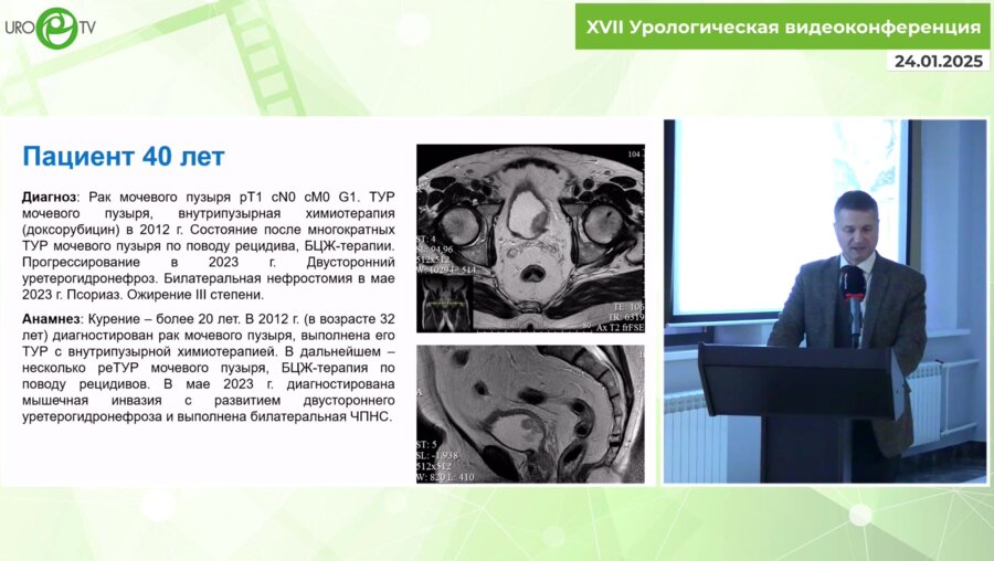 Монаков Д.М. - Робот-ассистированная цистпростатвезикулэктомия с интракорпоральным формированием необладдера
