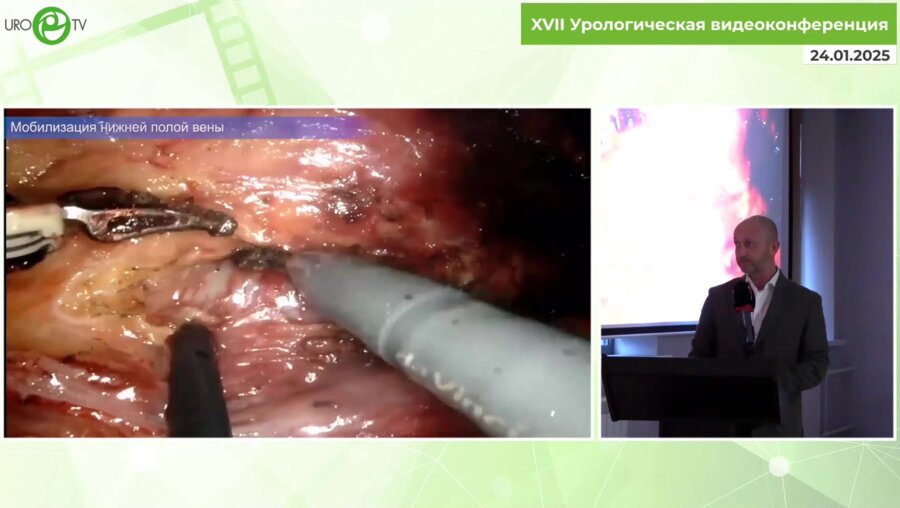Пакус С.М. - Робот-ассистированная радикальная нефрэктомия справа, тромбэктомия из нижней полой вены