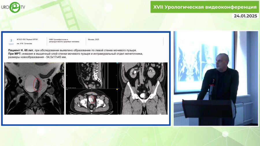 Суханов Р.Б. - Технические особенности en-bloc опухоли мочевого пузыря, расположенной в области устья