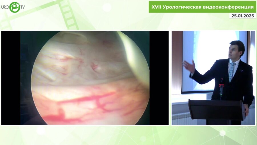 Волков С.Н. - Лапароскопическая радикальная простатэктомия+уретероцистонеоанастамоз+двусторонняя пластика паховых грыж