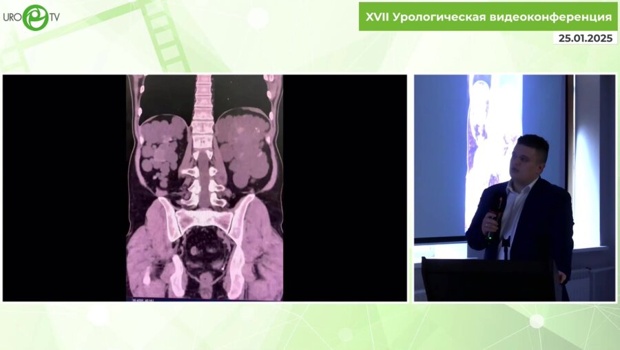 Медведев П.Е. - Особенности билатеральной нефрэктомии при поликистозе почек (суммарный объем 15 кг)
