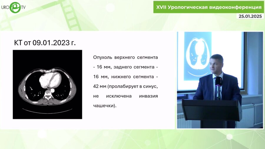 Монаков Д.М. - Резекция почки по поводу множественных новообразований в условиях изолированной фармакохолодовой ишемии кардиоплегическим раствором