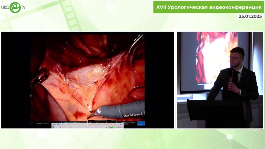 Павленко А.Г. - Робот-ассистированная радикальная цистэктомия с интракорпоральным формированием неоцистиса по Штудеру