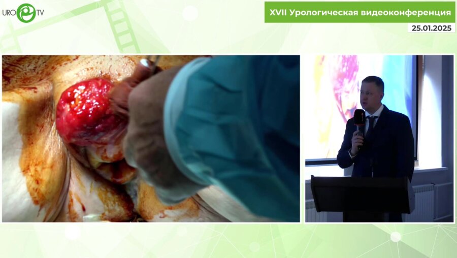 Пинчук И.С. - Коррекция тотального пролапса у женщины