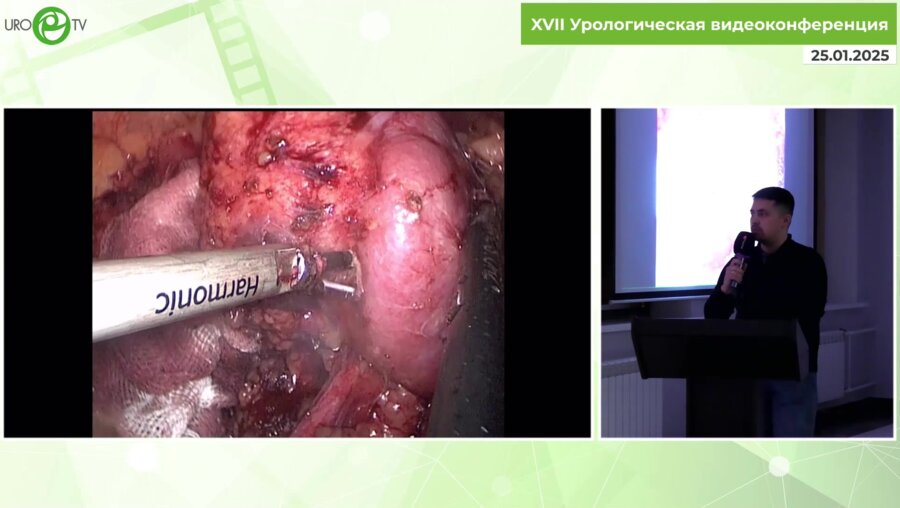 Подойницын А.А. - Лапароскопическая безишемийная резекция опухолей ворот почки