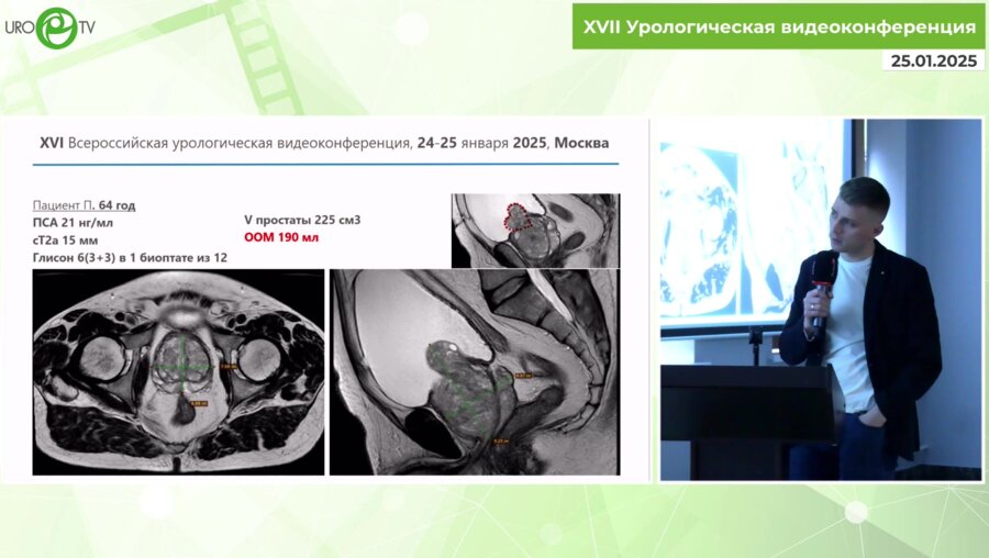 Собенин В.Г. -   Лапароскопическая радикальная простатэктомия Monster Size Prostate