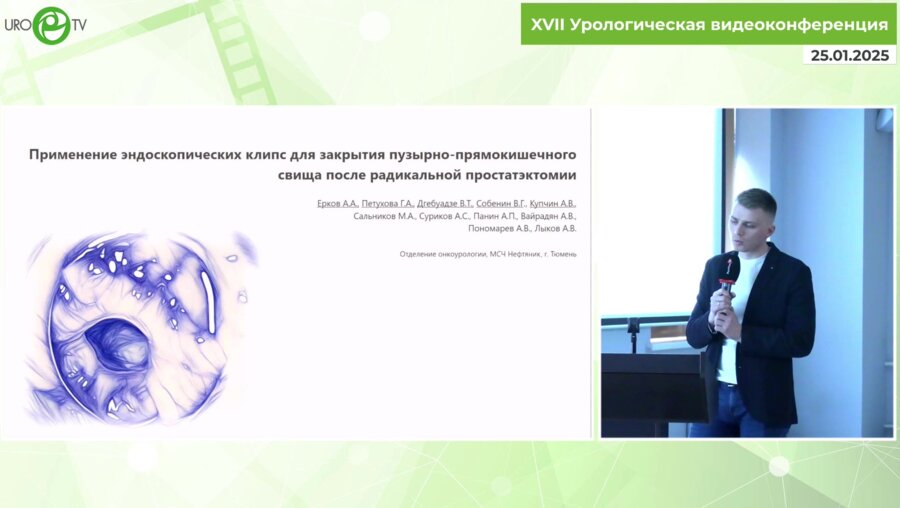 Собенин В.Г. -  Применение эндоскопических клипс для закрытия пузырно-прямокишечного свища после радикальной простатэктомии