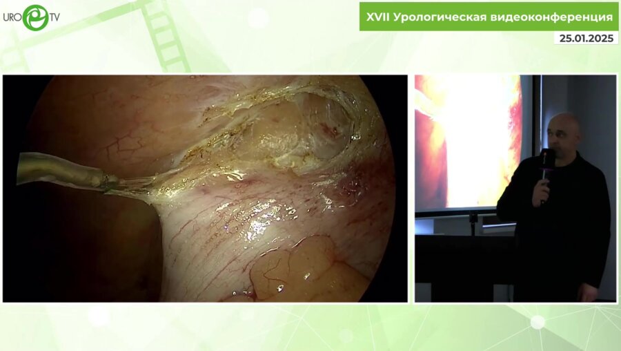 Шкодкин С.В. - Рецидивная аппендэктомия