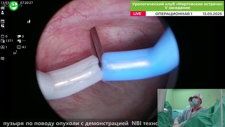 Орлов И.Н.  - Olympus Plasma и биполярная ТУР мочевого пузыря по поводу опухоли с демонстрацией NBI технологии