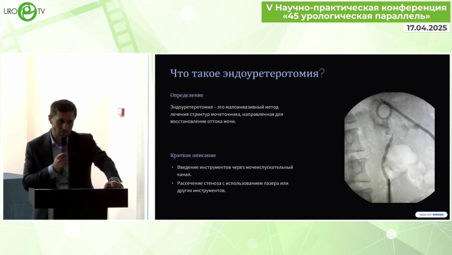 Гамзатов З.Г. - Эндоуретеротомия при стриктурах мочеточника. Актуальность в настоящее время