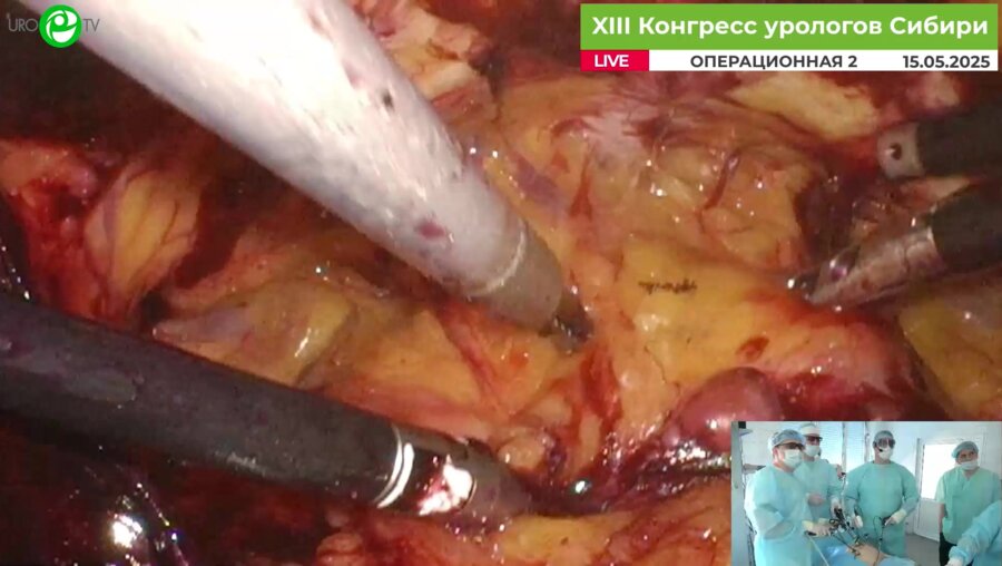 Орлов И.Н. - Лапароскопическая аденомэктомия