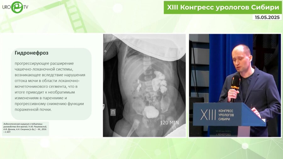 Сурцев К.С. - Лапароскопическая пиелопластика у пациентов детского возраста в Кузбассе