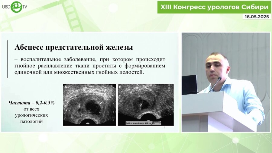 Мкртчян Д.М. - Хирургическое лечение абсцесса предстательной железы