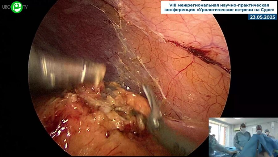 Миронов М.А. - Лапароскопическая резекция почки с использованием ультразвуковых ножниц EsyUS