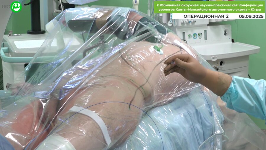 Андронов А.С. - Ультраминиперкутанная нефролитотрипсия