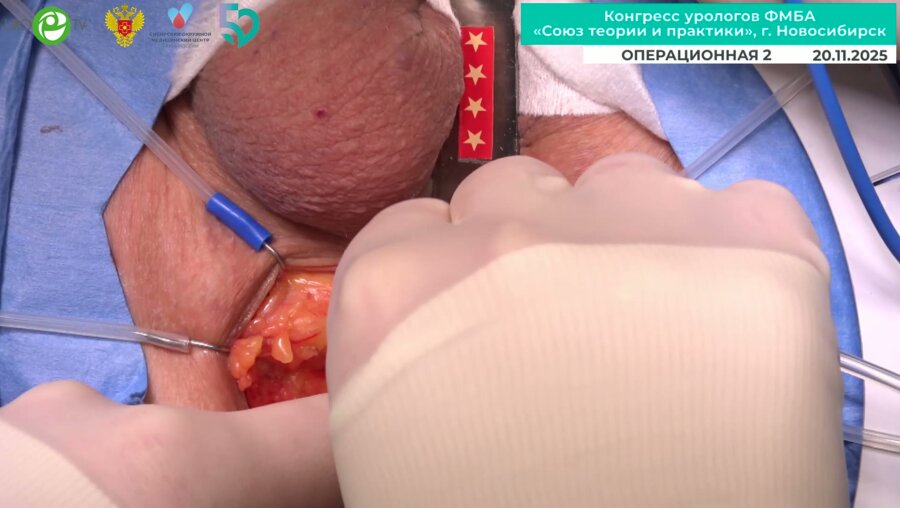 Кызласов П.С. - Слинговая уретропексия у мужчины