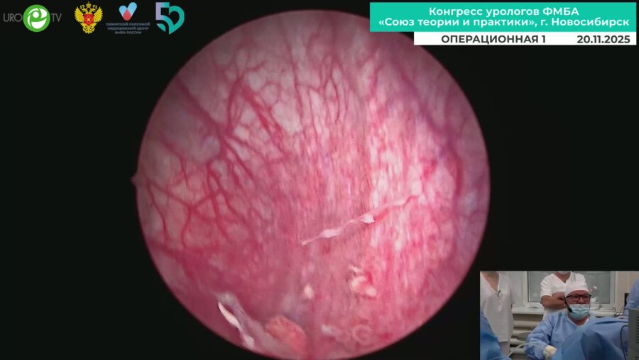 Мартов А.Г. - Трансуретральная биполярная резекция опухоли мочевого пузыря с PDD на Safira