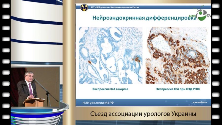 Сивков А.В. - "Определение тактики лечения больных РПЖ с доказанным нейроэндокринным статусом"