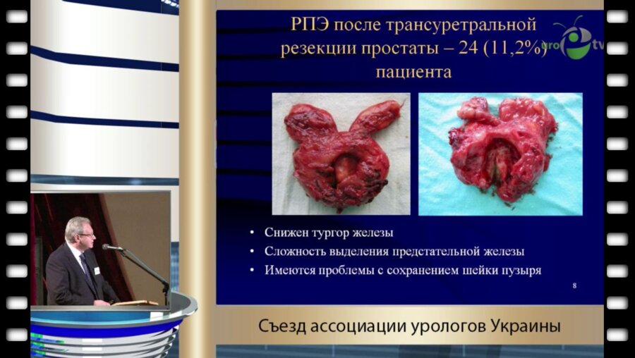 Щукин Д.В. - "Наш опыт радикальной простатэктомии"