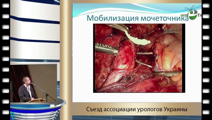 Серняк Ю.П. - "Опыт лапароскопической коррекции травм мочеточника при гинекологических операциях"