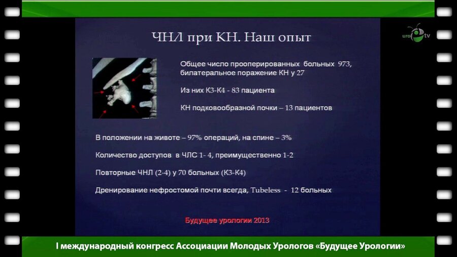 Берников Е.В. - "Перкутанный доступ в лечении коралловидных камней почек"
